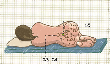 Punción lumbar